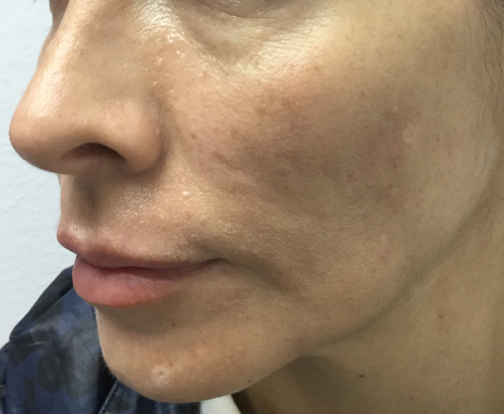 Melasma - Antes del tratamiento